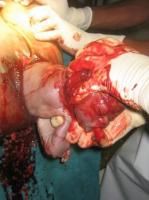 craniotomy-12_thumbnail.jpg