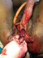 exvisceration-3_thumbnail.jpg