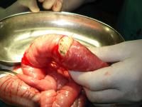 acaris-impaction3_thumbnail.jpg