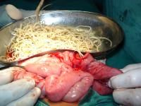 acaris-impaction5_thumbnail.jpg