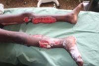 open-fracture-1_thumbnail.jpg