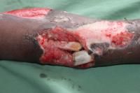 open-fracture-3_thumbnail.jpg