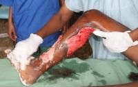 open-fracture-4_thumbnail.jpg