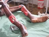 open-fracture-5_thumbnail.jpg