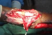 open-fracture-7_thumbnail.jpg