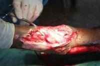 open-fracture-8_thumbnail.jpg