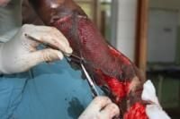 open-fracture-11_thumbnail.jpg
