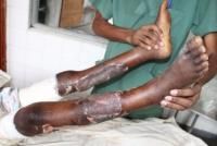 open-fracture-12_thumbnail.jpg