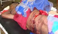 stab-wound-1_thumbnail.jpg