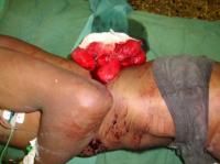 stab-wound-2_thumbnail.jpg