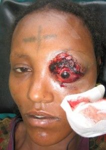eye-injury-2-211x300.jpg