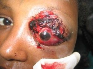 eye-injury-3-300x224.jpg