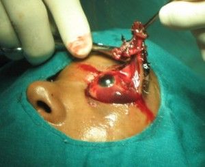 eye-injury-4-300x245.jpg