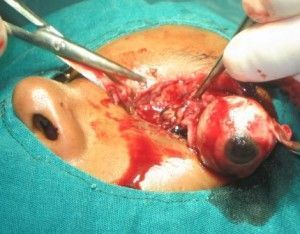 eye-injury-6-300x234.jpg