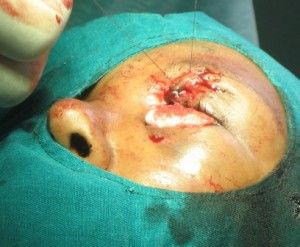 eye-injury-7-300x247.jpg