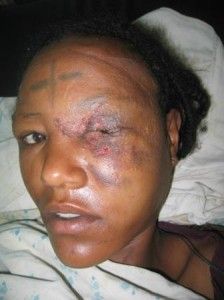 eye-injury-10-224x300.jpg