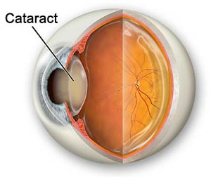 Name:  Cataract.jpg
Views: 709
Size:  10.8 KB