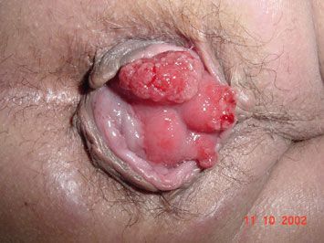 burst anus.jpg