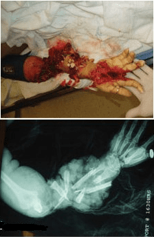 hand injury.PNG