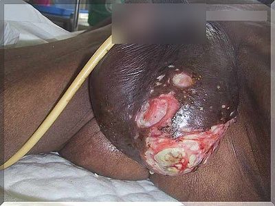 aids_039.jpg