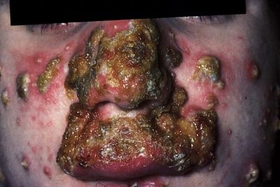 acne09.jpg
