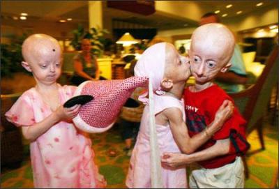 progeria.jpg
