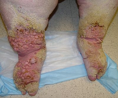 lymphedema_1_060802.jpg