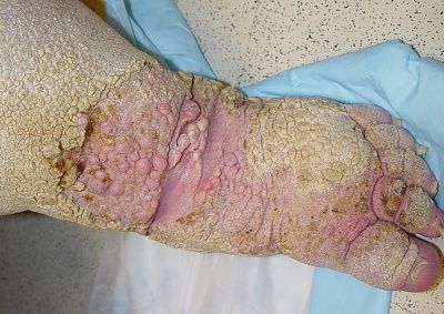lymphedema_2_060802.jpg