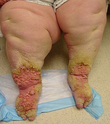 lymphedema_4_060802.jpg