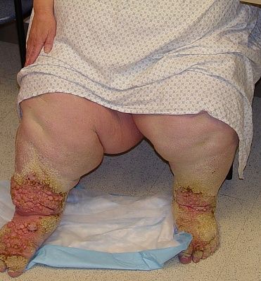 lymphedema_5_060802.jpg
