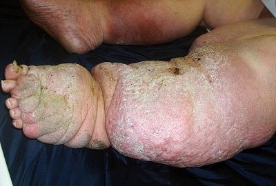 extremities_lymphedema3.jpg