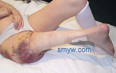 cancersurg1.jpg