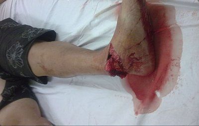 foot-break.jpg