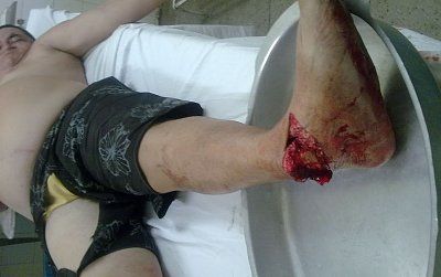 foot-break1.jpg