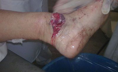 foot-break2.jpg