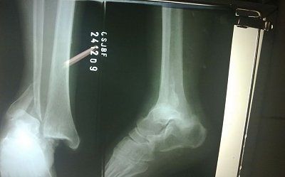 foot-break3.jpg