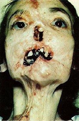syphilis.jpg