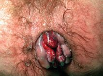 Stage4Hemorrhoids.jpg