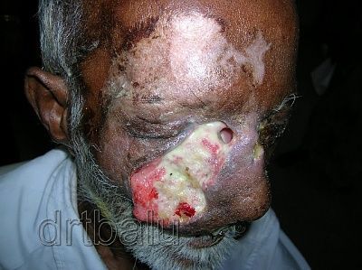 myiasis.jpg