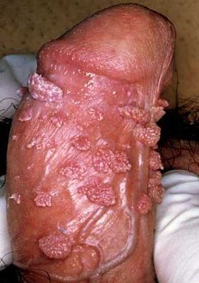 warts.jpg