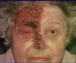 shingles.jpg