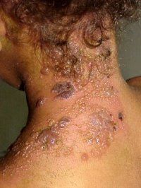 Neck_shingles.jpg