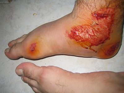 wound-open-abrasion-graze-scrape-injury-foot-ankle-healing-week-1-view-closeup-jv.jpg