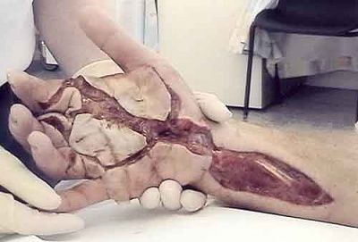 oil_injection_injury.jpg