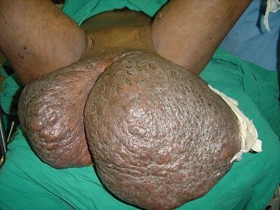 elephantiasis-vulva-1.jpg