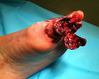 051211-toe-cut-off1.jpg