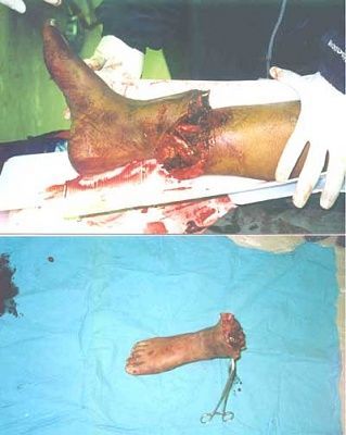 amputation.jpg