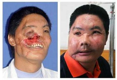 facetransplantme5.jpg