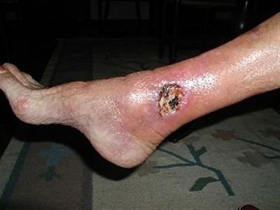 infection1.jpg