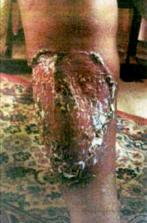 infection2.jpg